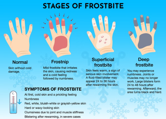 Frostbite