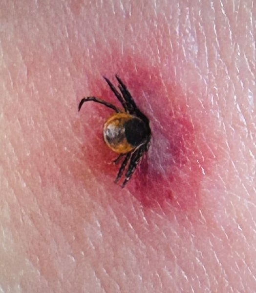 Partially embedded deer tick